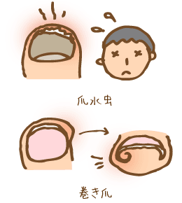 爪水虫　巻き爪