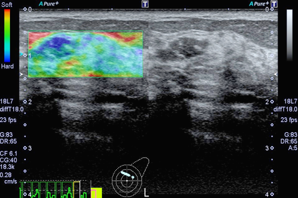 水俣市立総合医療センター臨床検査科乳腺エラストグラフィ