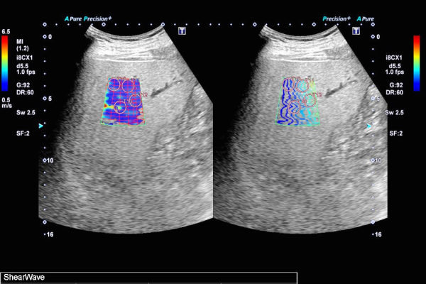 水俣市立総合医療センター臨床検査科肝エラストグラフィ