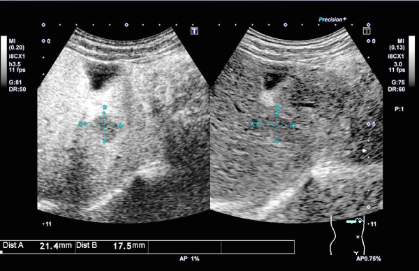 水俣市立総合医療センター臨床検査科肝ソナゾイド