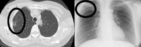 肺がんの発見率が2倍に上昇